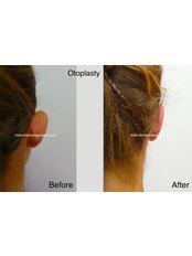 Ear Pinning - Dr Siripong Surgery