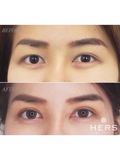 Double Eyelid Surgery - HERS clinic