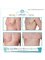 Rattinan Clinic - Gynecomastia: before the surgery and 4 weeks after surgery 