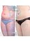 Rattinan Clinic - Bodytite liposuction after one month 