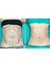 Liposuction - The Art Clinic