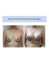Breast Lift - The Sib Clinic
