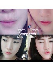 Lip Augmentation - Sompetch Aesthetic Clinic