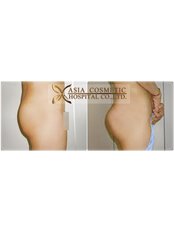 Butt augmentation  - Asia Cosmetic Hospital