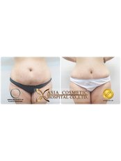Liposuction - Asia Cosmetic Hospital