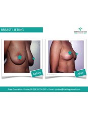 Breast Lift - Carthago Med