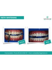 Zoom! Teeth Whitening - Carthago Med