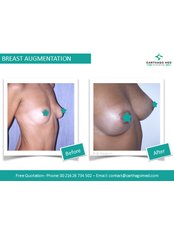 Breast Implants - Carthago Med