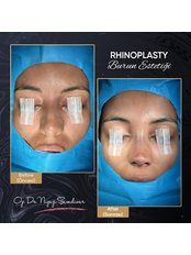 Rhinoplasty - Op. Dr. Niyazi Şimdivar NISH Clinic