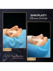 Rhinoplasty - Op. Dr. Niyazi Şimdivar NISH Clinic