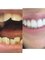 Aspro Atlantic plastic surgery - Dental Veneers 