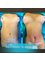 Aspro Atlantic plastic surgery - Mini Tummy Tuck  & Breast Implants 
