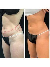 Liposuction - HealinTurkey Clinics Group