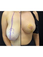 Breast Reduction - Omer Ekin, Aesthetic Surgery Body Contouring Clinic Ankara