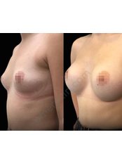 Breast Implants - Omer Ekin, Aesthetic Surgery Body Contouring Clinic Ankara