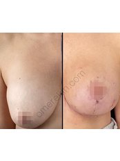 Breast Lift - Omer Ekin, Aesthetic Surgery Body Contouring Clinic Ankara