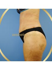 Mini Abdominoplasty - Aesthetics Antalya