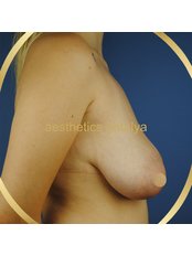 Breast Lift - Aesthetics Antalya