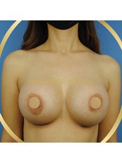 Breast Implants - Aesthetics Antalya