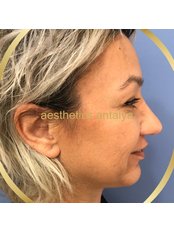 Chin Implant - Aesthetics Antalya