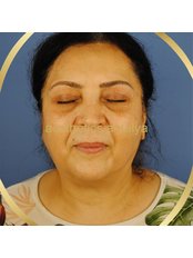 Eyelid Surgery - Aesthetics Antalya