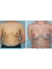 Breast Implants - CatchLife - Dr. Bahadır Çelik