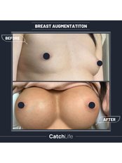 Brustimplantate - Catch Life Aesthetic