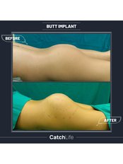 Butt Implants - CatchLife