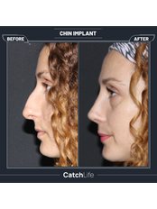 Chin Implant - CatchLife