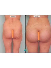 Butt Implants - Clinic Ways