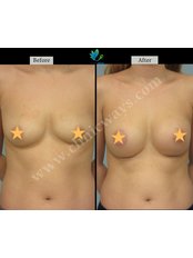Breast Implants - Clinic Ways