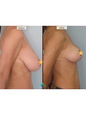 Breast Reduction - Clinic Ways