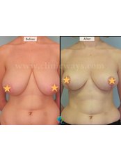 Breast Reduction - Clinic Ways