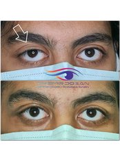 Ptosis - Dr.Emir Doğan - Oculoplastic Surgery
