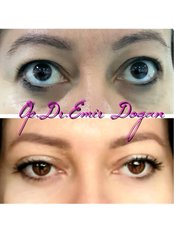Almond Eyes Surgery-  (Canthoplasty) - Dr.Emir Doğan - Oculoplastic Surgery