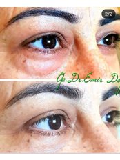 Eye Bags Surgery (Lower) - Dr.Emir Doğan - Oculoplastic Surgery