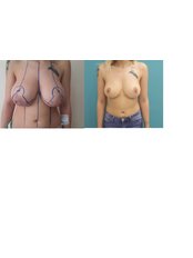 Breast Implants - Estemita Aesthetics