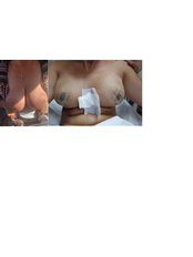 Breast Reconstruction - Estemita Aesthetics