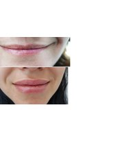 Lip Augmentation - Estemita Aesthetics
