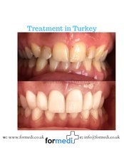 Porcelain Crown - Formedi Clinic Turkey