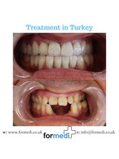 Dental Bridges - Formedi Clinic Turkey