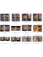 Liposuction - Formedi Clinic Turkey