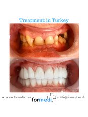 Dental Implants - Formedi Clinic Turkey