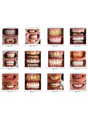 Dental Crowns - Formedi Clinic Turkey
