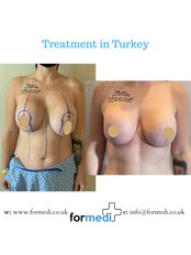 Breast Implant Revision - Formedi Clinic Turkey