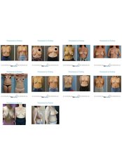 Breast Reduction - Formedi Clinic Turkey