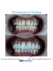 Veneers - Formedi Clinic Turkey