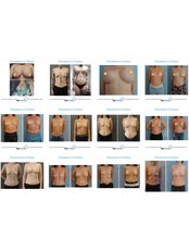 Breast Implants - Formedi Clinic Turkey