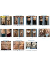 Liposuction - Formedi Clinic Turkey