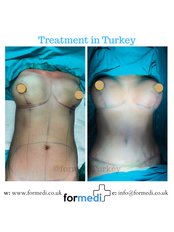 Mommy Makeover - Formedi Clinic Turkey